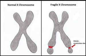 Fragile x syndrome symptoms