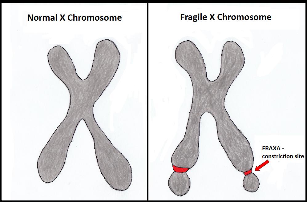 signs-and-symptoms-of-fragile-x-syndrome-autistic-advisor